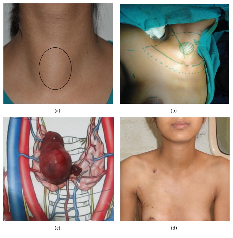 Feasibility of Endoscopic Thyroidectomy via Axilla and Breast Approaches for Larger Goiters: Widening the Horizons.