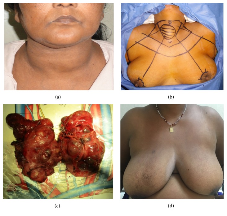 Feasibility of Endoscopic Thyroidectomy via Axilla and Breast Approaches for Larger Goiters: Widening the Horizons.