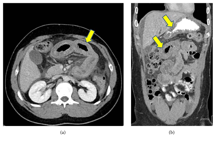 Hereditary Angioedema Type II: First Presentation in Adulthood with Recurrent Severe Abdominal Pain.