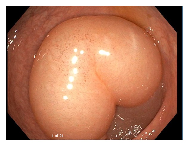 Hereditary Angioedema Type II: First Presentation in Adulthood with Recurrent Severe Abdominal Pain.