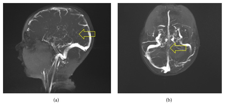 Unilateral Thalamic Venous Infarction in an Infant: A Rare Presentation of Bilateral Deep Cerebral Venous Thrombosis.