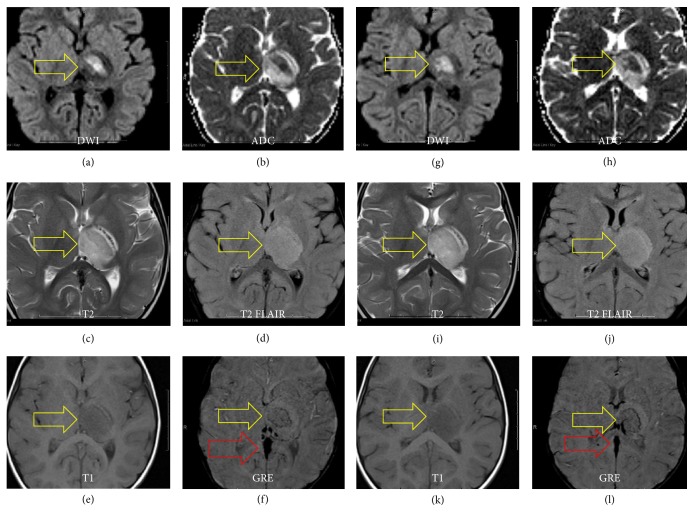 Unilateral Thalamic Venous Infarction in an Infant: A Rare Presentation of Bilateral Deep Cerebral Venous Thrombosis.