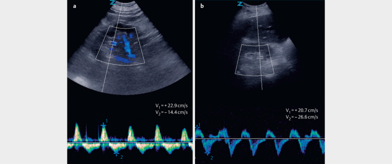 Sonographic Venous Velocity Index Identifies Patients with Chronic Kidney Disease and Severe Diastolic Dysfunction.