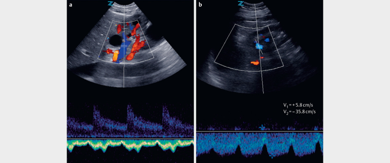 Sonographic Venous Velocity Index Identifies Patients with Chronic Kidney Disease and Severe Diastolic Dysfunction.