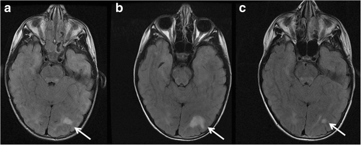 Cerebellar radiological abnormalities in children with neurofibromatosis type 1: part 2 - a neuroimaging natural history study with clinical correlations.