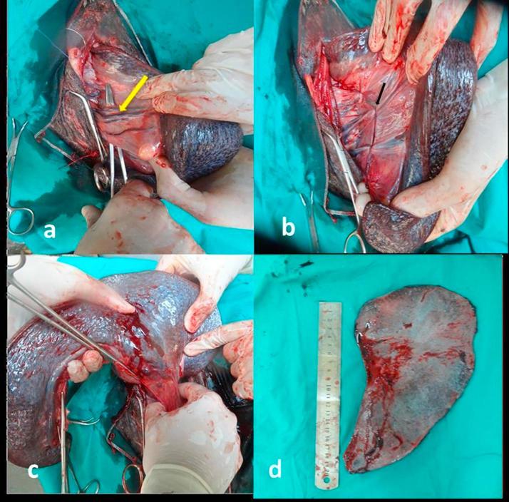 Ultrasonography guidance for total splenectomy in donkeys