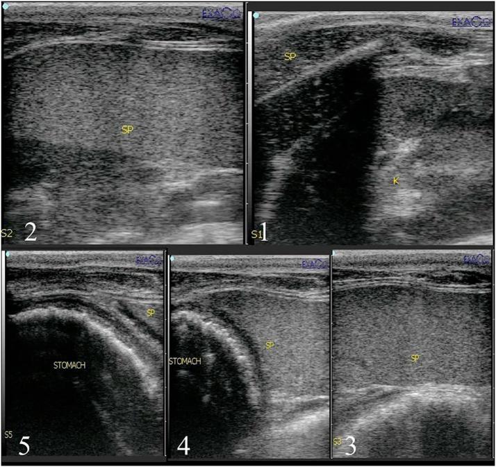 Ultrasonography guidance for total splenectomy in donkeys