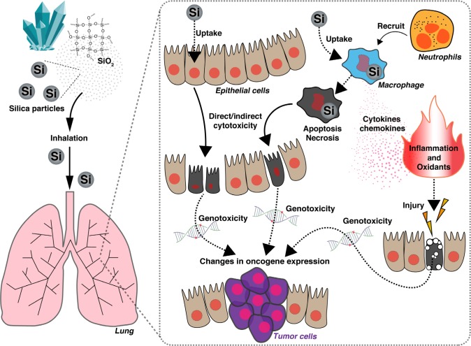 Silicosis and lung cancer: current perspectives.