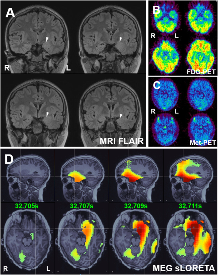 Anatomo-electro-clinical correlations of hypermotor seizures with amygdala enlargement: Hippocampal seizure origin identified using stereoelectroencephalography