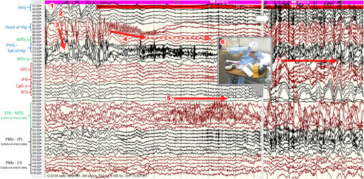 Anatomo-electro-clinical correlations of hypermotor seizures with amygdala enlargement: Hippocampal seizure origin identified using stereoelectroencephalography