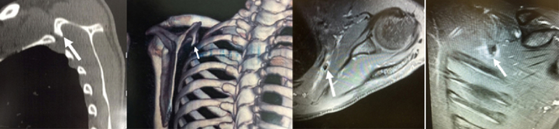 Snapping scapula syndrome: arthroscopic surgical treatment