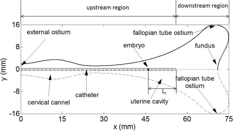 Numerical simulation of embryo transfer: how the viscosity of transferred medium affects the transport of embryos.