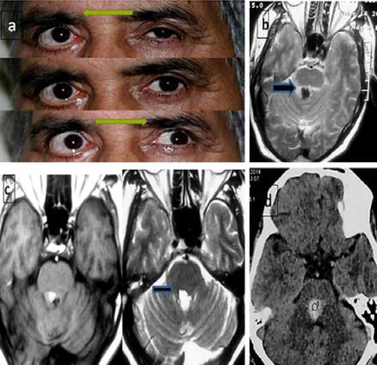 "Eight and a half" and "nine syndrome" rare presentation of pontine lesions; case reports and review of literature.