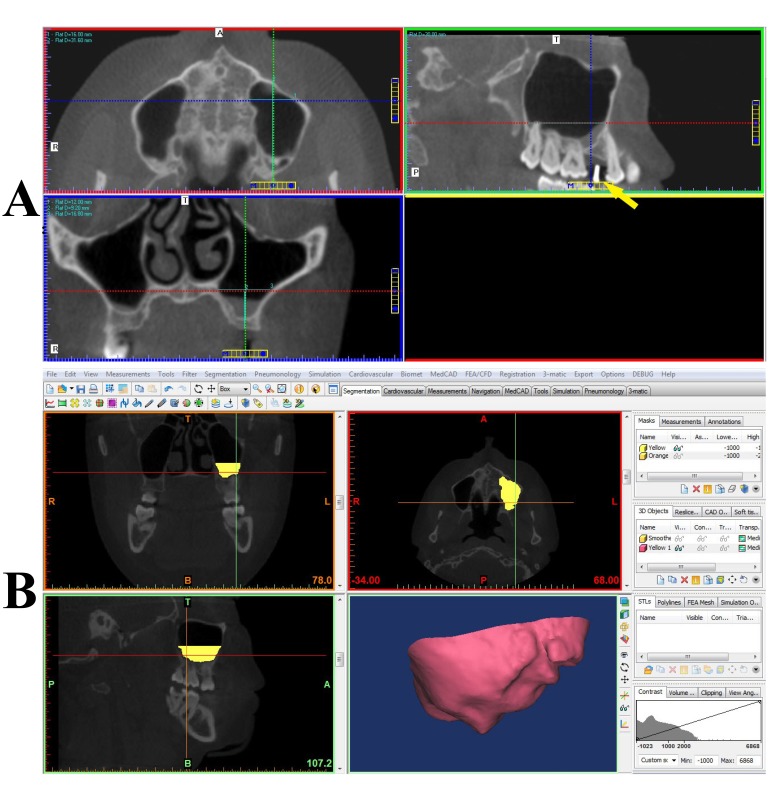 Cone Beam CT-Based Preoperative Volumetric Estimation of Bone Graft Required for Lateral Window Sinus Augmentation, Compared with Intraoperative Findings: A Pilot Study.