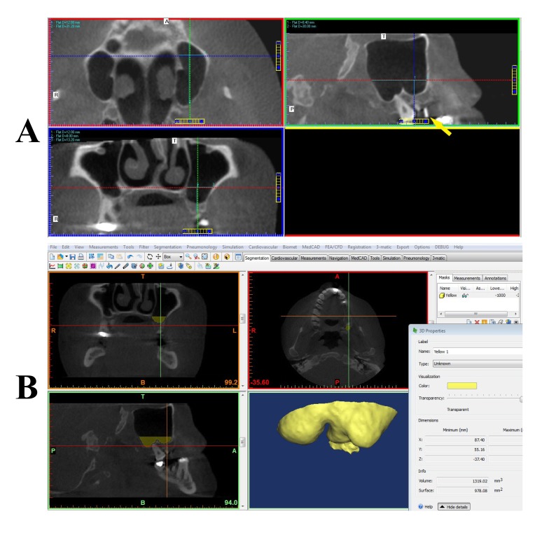 Cone Beam CT-Based Preoperative Volumetric Estimation of Bone Graft Required for Lateral Window Sinus Augmentation, Compared with Intraoperative Findings: A Pilot Study.