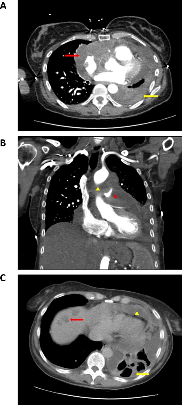 Regression of primary cardiac angiosarcoma and metastatic nodules following propranolol as a single agent treatment.