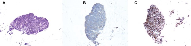 Non-small cell to small cell lung cancer on PD-1 inhibitors: two cases on potential histologic transformation.