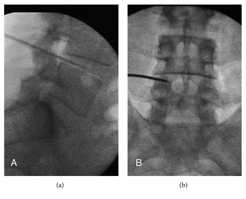 The Frequency of Resurgery after Percutaneous Lumbar Surgery Using Dekompressor in a Ten-Year Period.