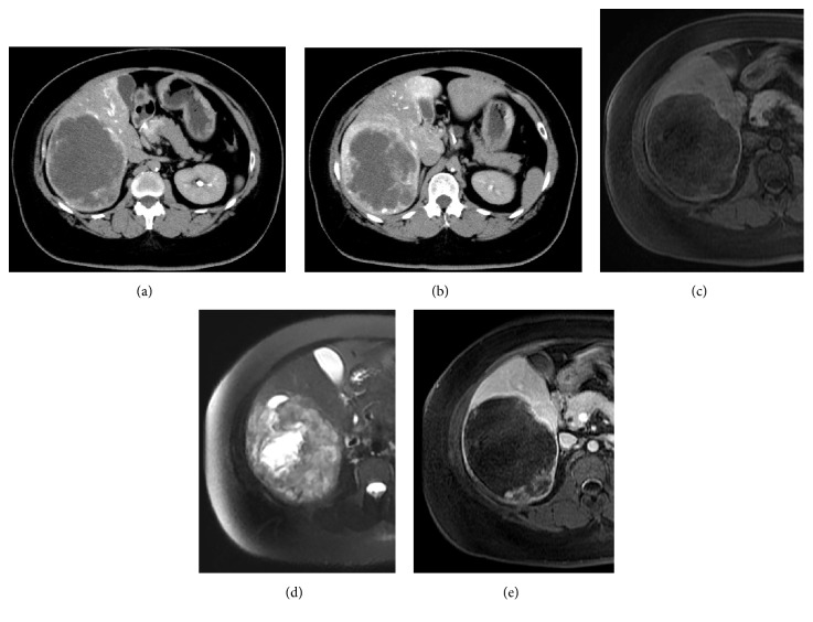 Hepatic Sclerosing Hemangioma with Predominance of the Sclerosed Area Mimicking a Biliary Cystadenocarcinoma.