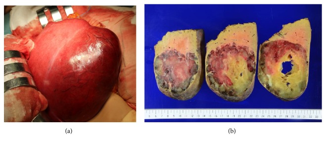 Hepatic Sclerosing Hemangioma with Predominance of the Sclerosed Area Mimicking a Biliary Cystadenocarcinoma.
