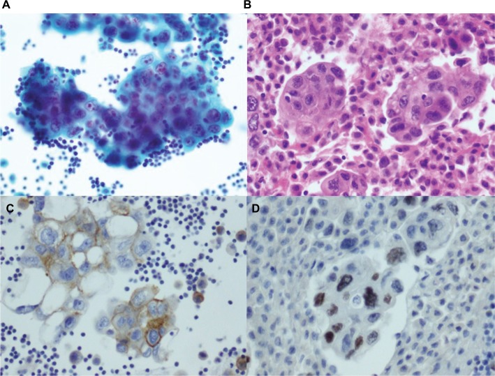 Non-small cell to small cell lung cancer on PD-1 inhibitors: two cases on potential histologic transformation.