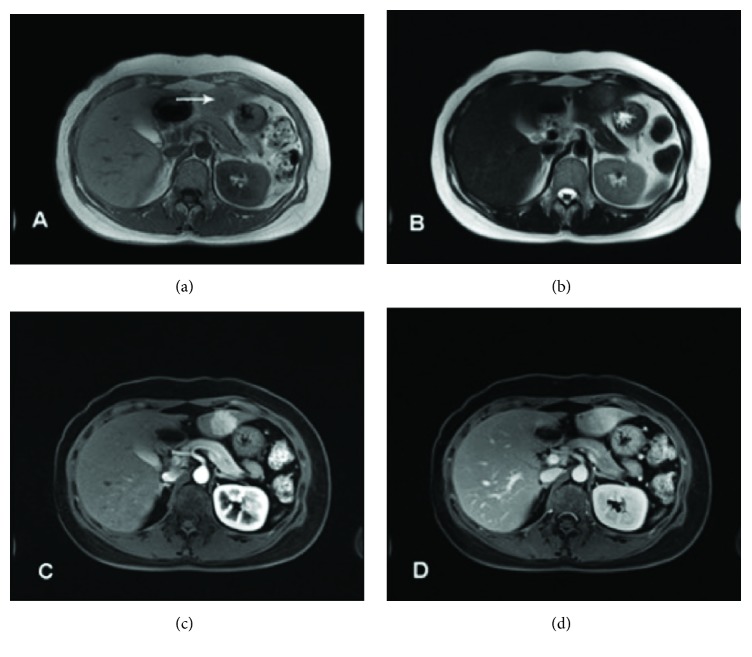 Development of Focal Nodular Hyperplasia after Cyclophosphamide-Based Chemotherapy in a Patient with Breast Cancer.