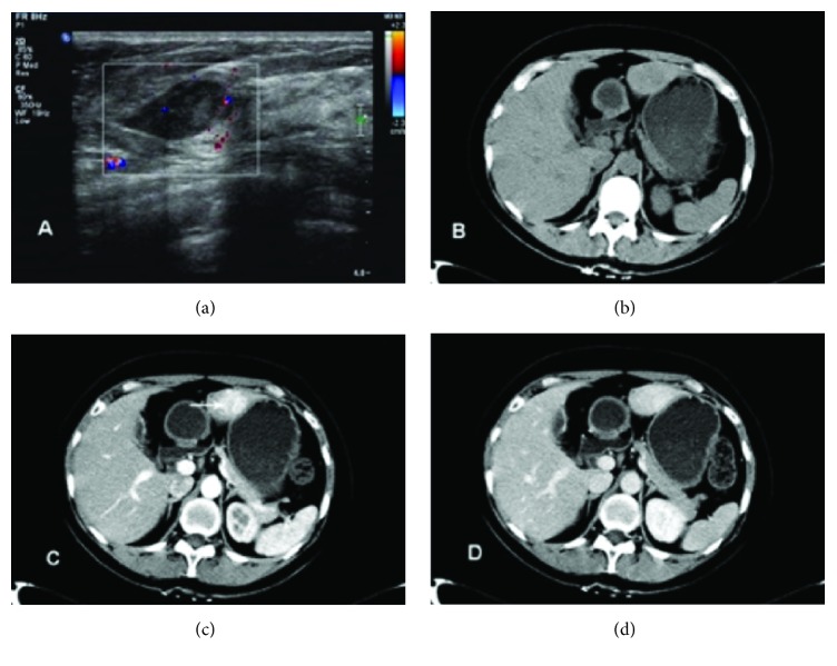 Development of Focal Nodular Hyperplasia after Cyclophosphamide-Based Chemotherapy in a Patient with Breast Cancer.