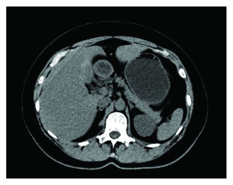 Development of Focal Nodular Hyperplasia after Cyclophosphamide-Based Chemotherapy in a Patient with Breast Cancer.