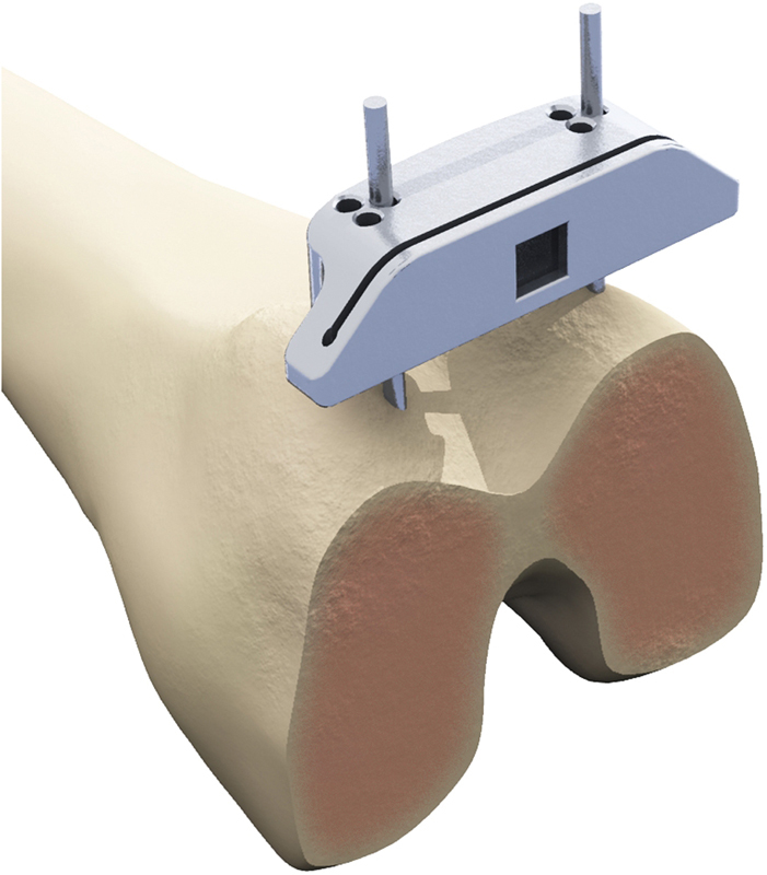 Evaluation of Blood Loss and Implant Alignment after Total Knee Arthroplasty with Inertial Based Extramedullary Femoral Cutting Guide.