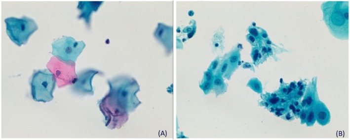 Pelvic radiotherapy for cervical cancer affects importantly the reproducibility of cytological alterations evaluation.