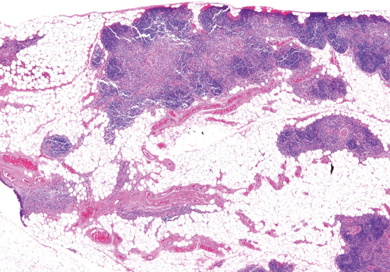 Phantom Nodules Detected by Ultrasound Examination of the Neck: The Possibility of Ectopic Cervical Thymic Tissue in Adults.