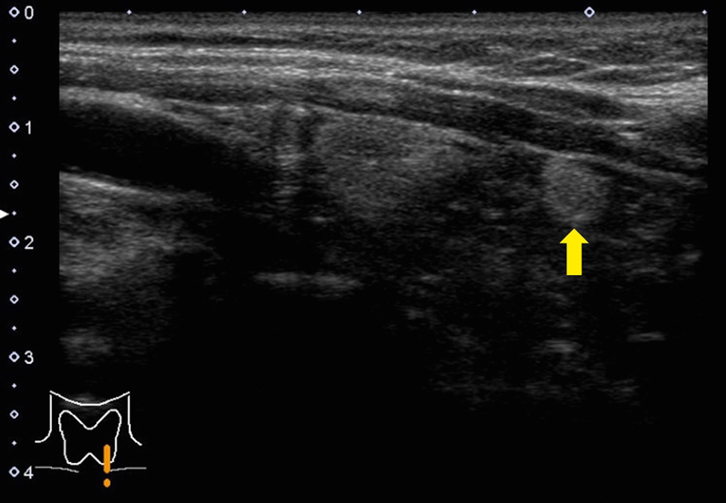 Phantom Nodules Detected by Ultrasound Examination of the Neck: The Possibility of Ectopic Cervical Thymic Tissue in Adults.