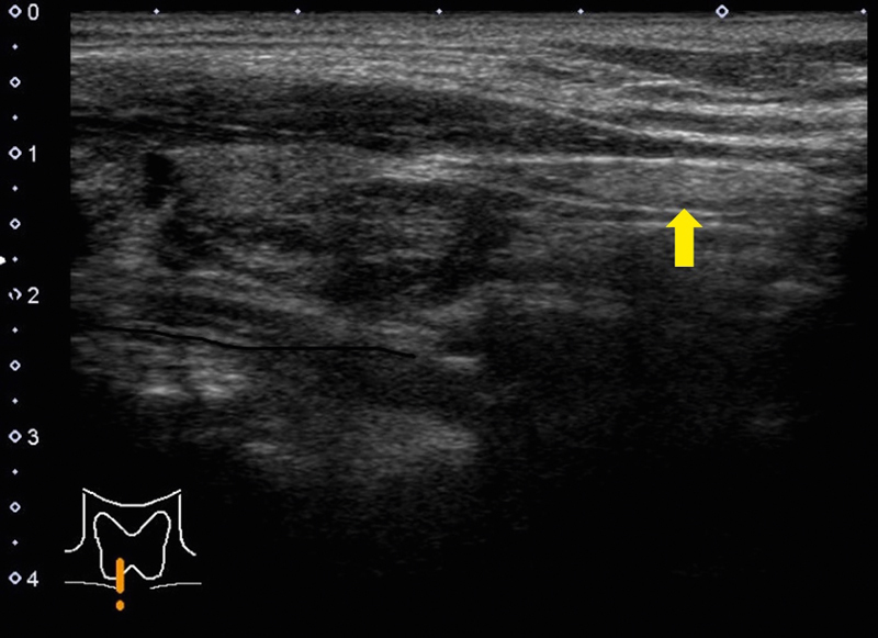 Phantom Nodules Detected by Ultrasound Examination of the Neck: The Possibility of Ectopic Cervical Thymic Tissue in Adults.