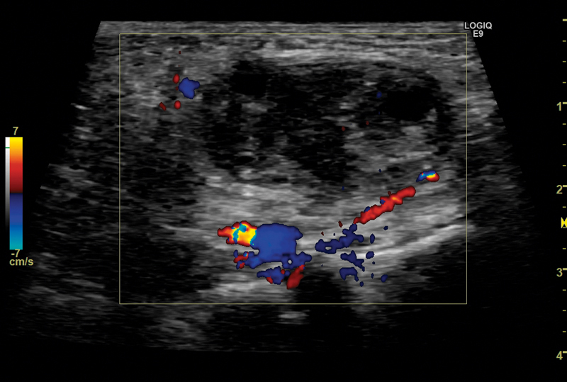 An Atypical Inguinal Hernia in a 9-Month-Old Girl - Case Report and Ultrasound Findings.