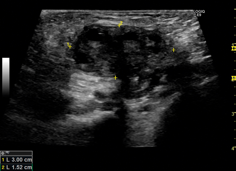 An Atypical Inguinal Hernia in a 9-Month-Old Girl - Case Report and Ultrasound Findings.