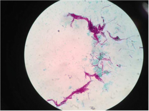 Primary cutaneous nocardiosis: a diagnosis of consideration in a renal transplant recipient.