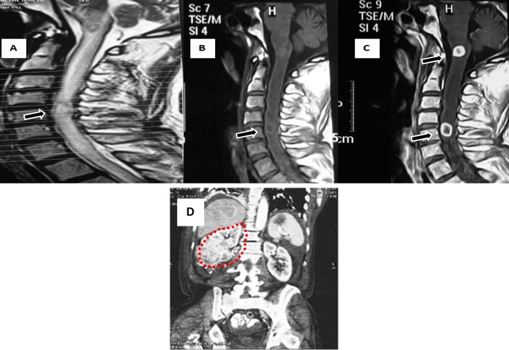 Longitudinally extensive myelitis as first presentation of renal cell carcinoma.