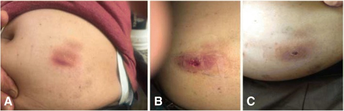 Primary cutaneous nocardiosis: a diagnosis of consideration in a renal transplant recipient.