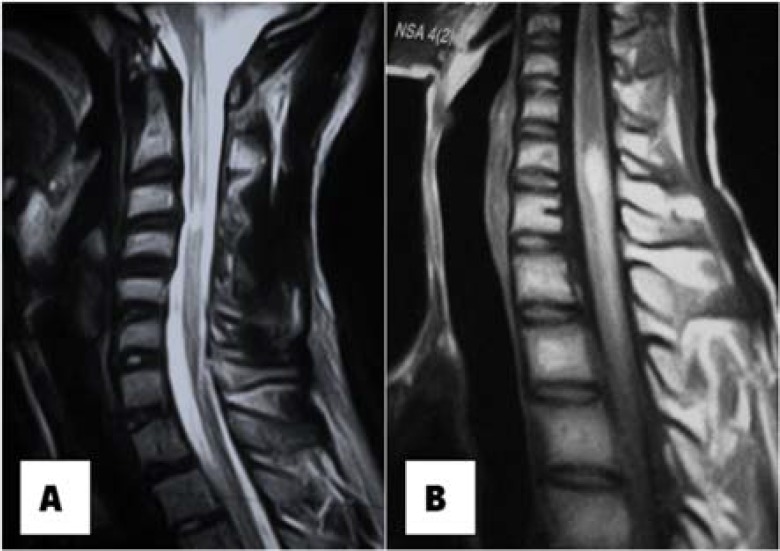 Medullar Kock without Pott: 13 cases observed at the university hospital center of Conakry, Guinea.