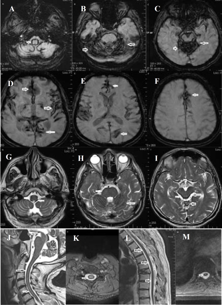 Iron chelation in treatment of superficial siderosis.