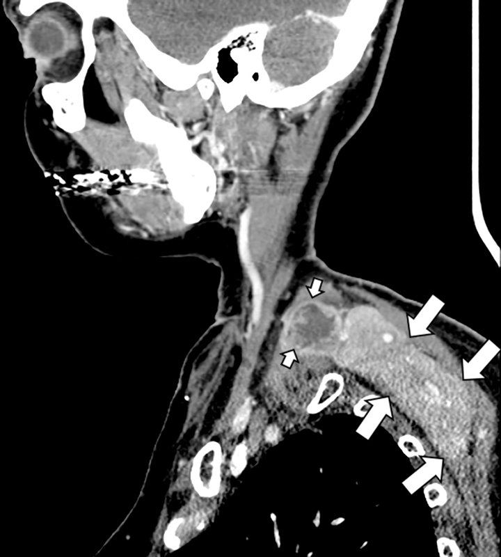 Myofibrosarcoma Mimicking a Vascular Thrombosis: A Case Report.