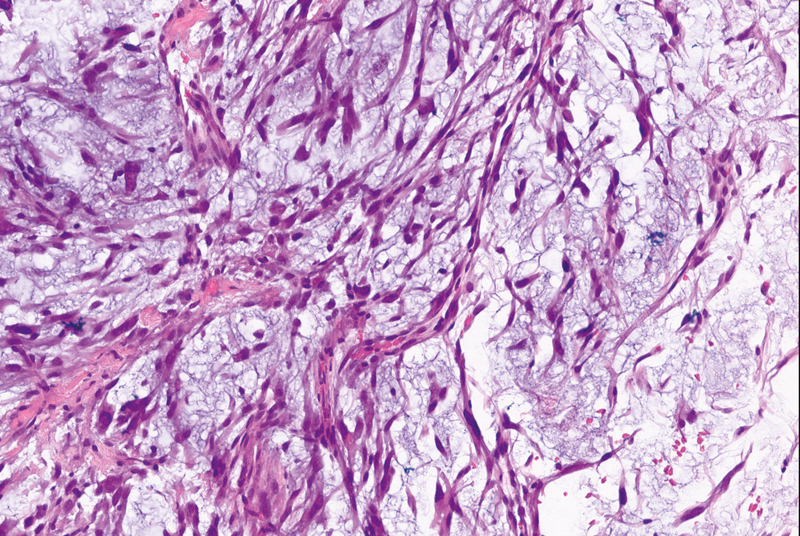 Myofibrosarcoma Mimicking a Vascular Thrombosis: A Case Report.