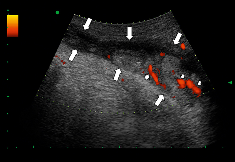 Myofibrosarcoma Mimicking a Vascular Thrombosis: A Case Report.