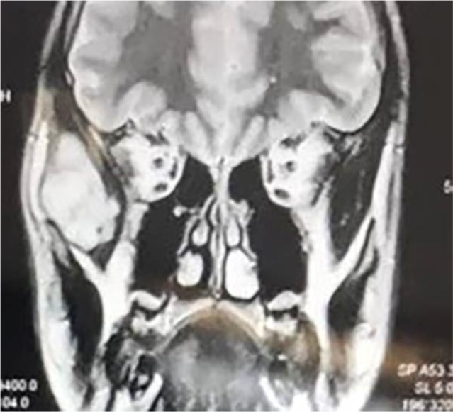 Extraskeletal Ewing Sarcoma: Report of an Extremely Rare Case in Temporal Region.