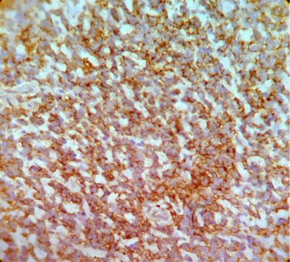 Extraskeletal Ewing Sarcoma: Report of an Extremely Rare Case in Temporal Region.