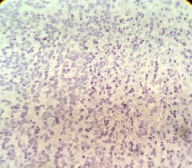 Extraskeletal Ewing Sarcoma: Report of an Extremely Rare Case in Temporal Region.