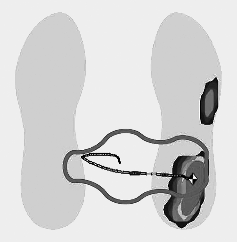 Lumbar Spine Injuries: Primary Prevention in Amateur and Professional Golf Players.