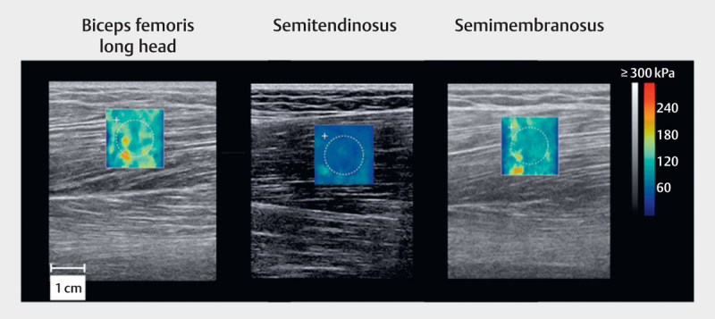 Acute Effect of Active and Passive Static Stretching on Elastic Modulus of the Hamstrings.