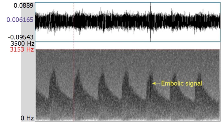 Microembolic signal detection by transcranial Doppler: Old method with a new indication.