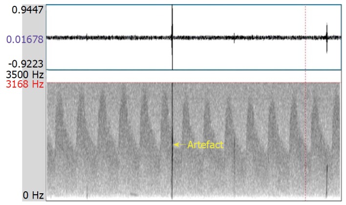 Microembolic signal detection by transcranial Doppler: Old method with a new indication.